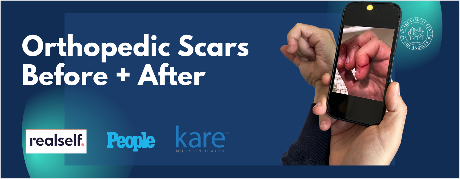 Orthopedic Scar Treatment in Los Angeles Karamanoukian Kare Plastic Surgery