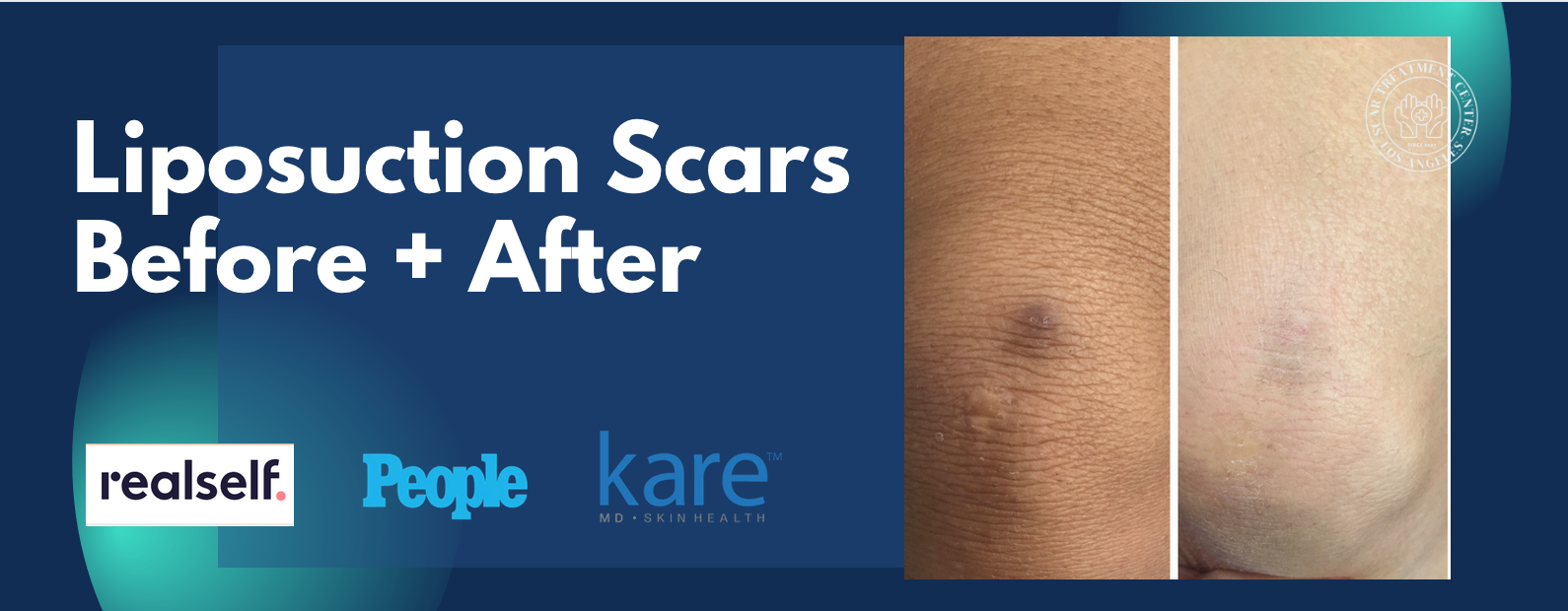 Liposuction Scar Removal with Kare Plastic Surgery Keloids and Hypertrophic Scar Los Angeles