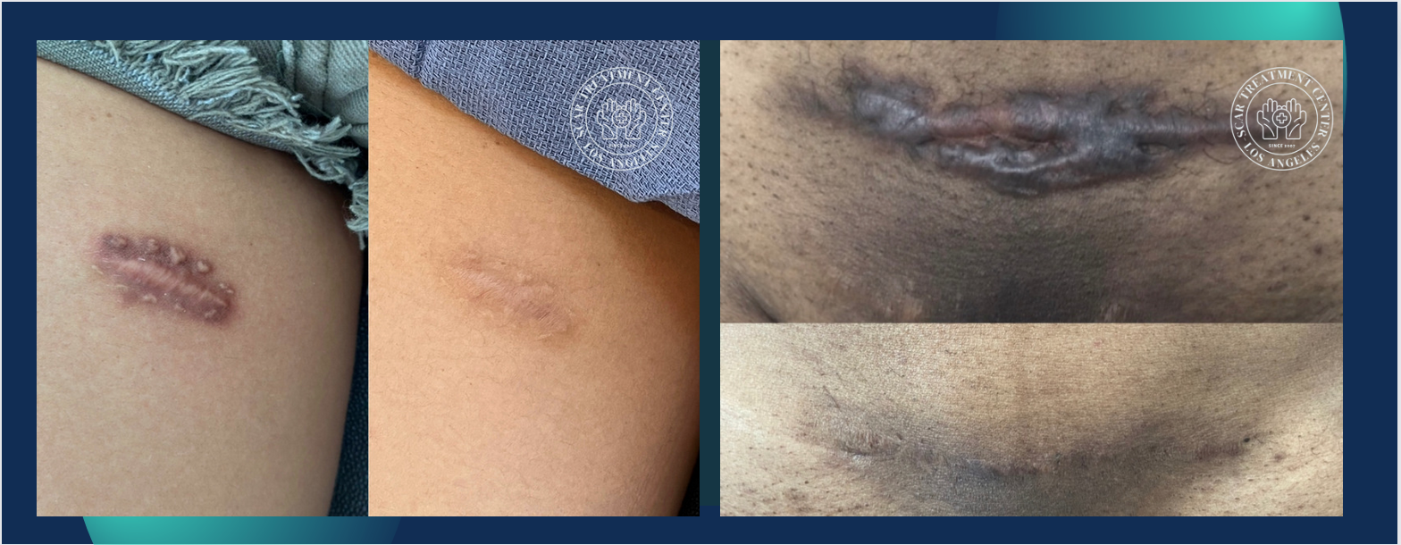 Before and After Hypertrophic Scars from C-section or Stitches in Los Angeles